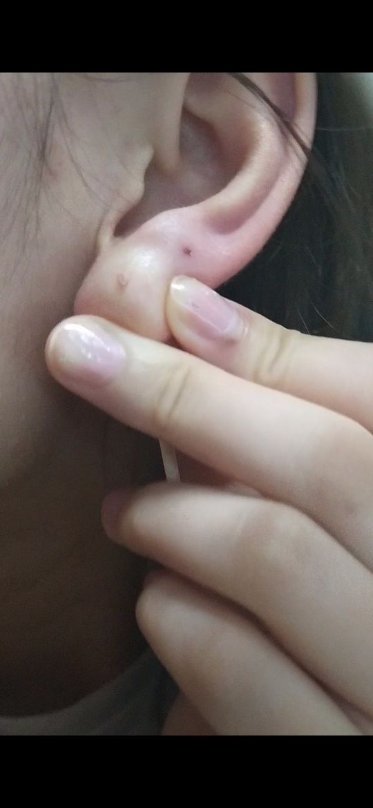 呜呜呜救命打耳洞一个多月了最近发现一挤就会有一圈还是一个这样的脓