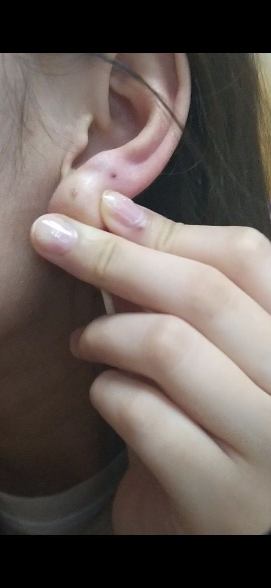 呜呜呜救命打耳洞一个多月了最近发现一挤就会有一圈还是一个这样的脓