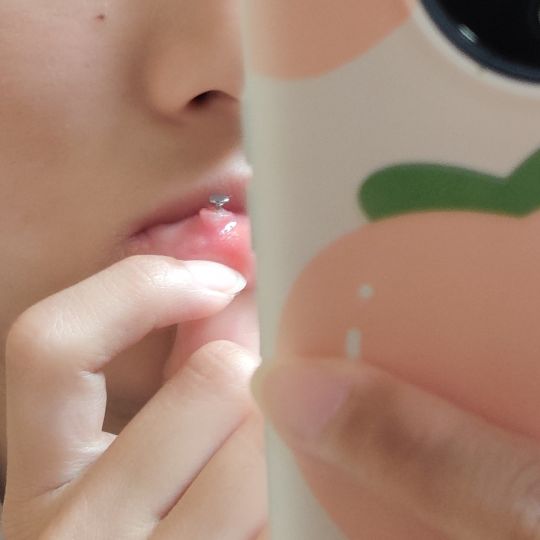 唇钉扎了好久了今天睡醒突然这样了旁边的肉鼓出来了但是不疼
