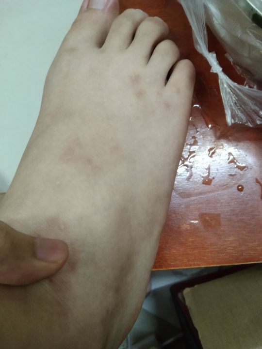 我昨晚下楼梯踩空把脚给崴了,当时痛得我站不起来,好… - 最右