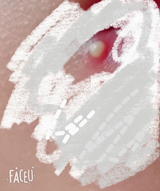 嘴角长了个白色的东西这玩意儿能挤吗