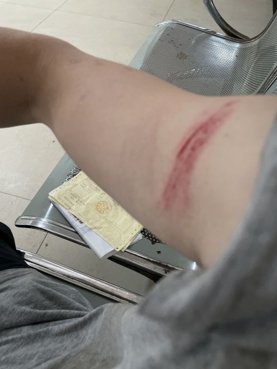 头先落地戴了头盔所以没事,手臂有明显外伤,有没有懂的朋友出来支个招