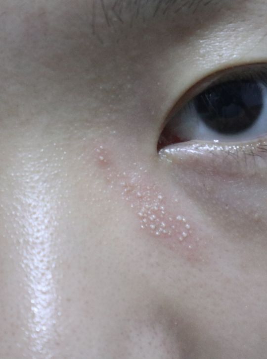 我两年前就是因为脸被飞蛾扑了,结果脸肿的跟个猪头一样,皮肤还都是