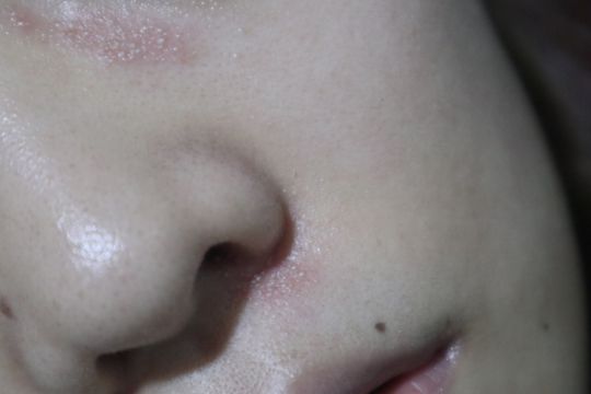 我两年前就是因为脸被飞蛾扑了,结果脸肿的跟个猪头一样,皮肤还都是